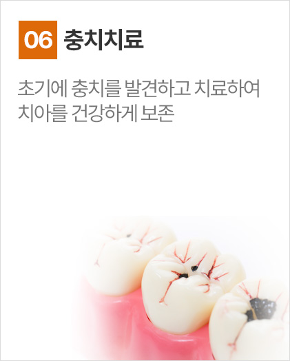 충치치료