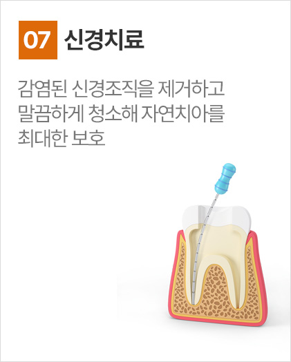 신경치료