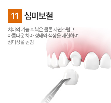 심미보철