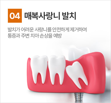 매복사랑니 발치