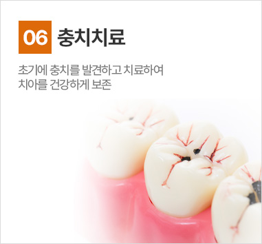 충치치료