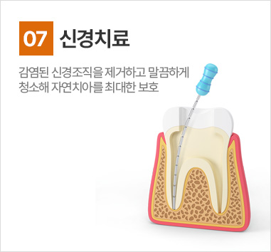 신경치료